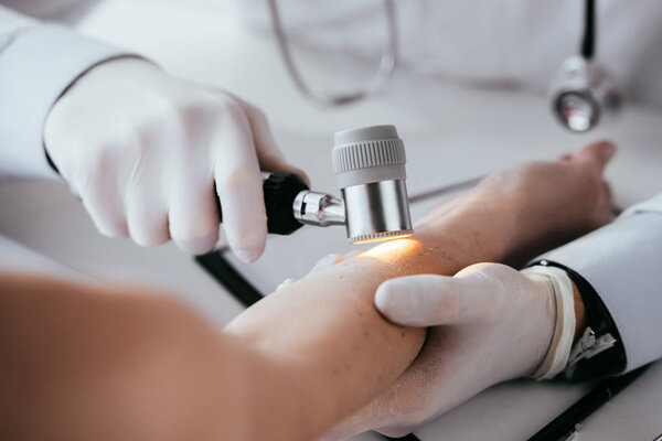 cropped view of dermatologist examining hand of woman while holding dermatoscope 