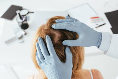 overhead view of dermatologist in blue latex gloves examining hair of patient in clinic 
