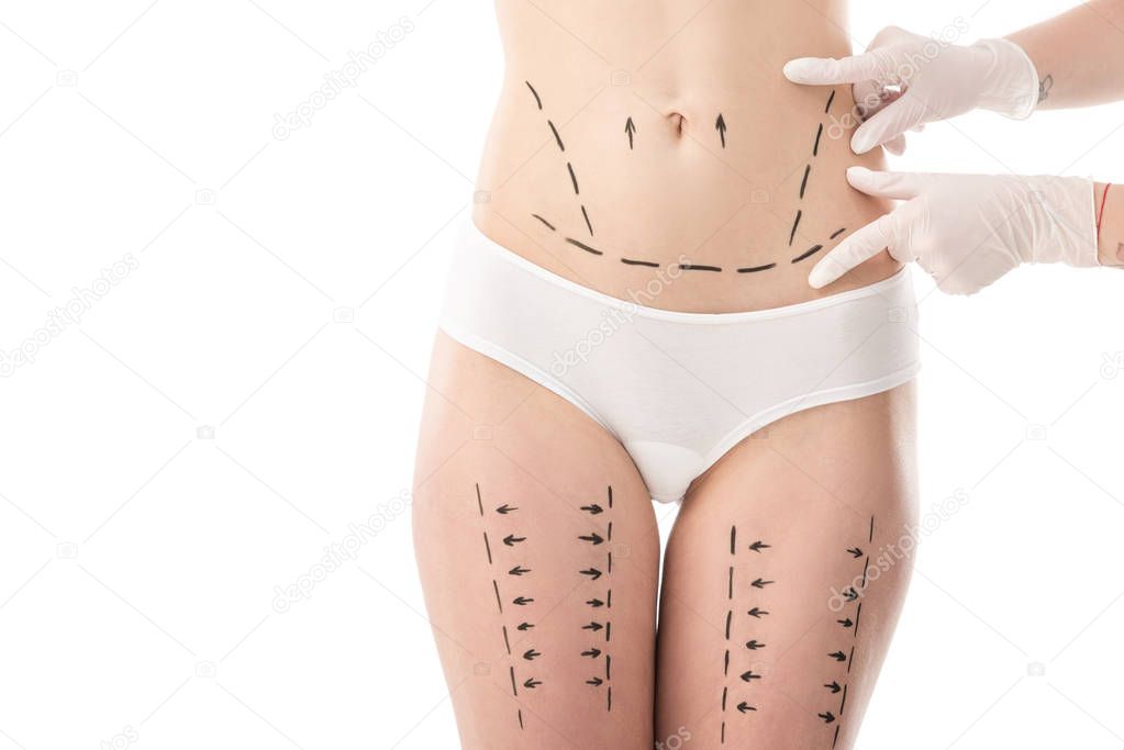 cropped view of plastic surgeon in latex gloves and patient in panties with marks on belly and hips isolated on white
