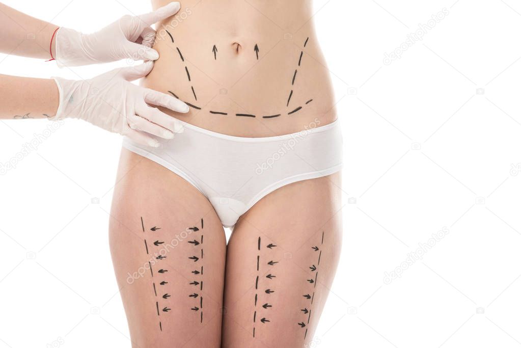 cropped view of plastic surgeon in latex gloves and patient in panties with marks on belly and hips isolated on white