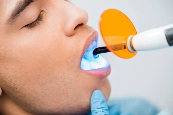 Close up of handsome african american man during bleaching procedure — Stock Photo