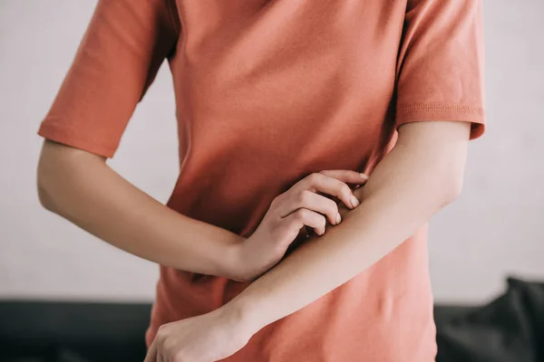 Cropped view of woman scratching hand while having allergy — Stock Photo