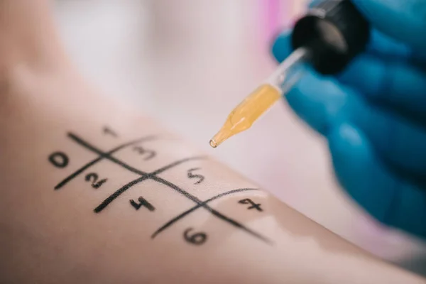 Close up of doctor holding pipette with liquid near marked female hand — Stock Photo