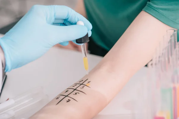 Обрезанный взгляд врача в латексной перчатке, держащего пипетку с жидкостью во время теста на аллергию на женщину — стоковое фото