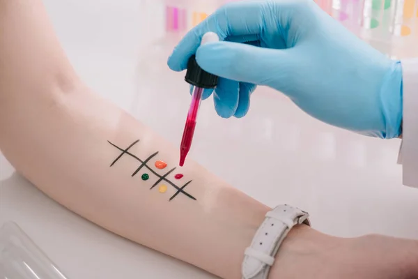 Cropped view of doctor holding pipette with liquid while making allergy test — Stock Photo