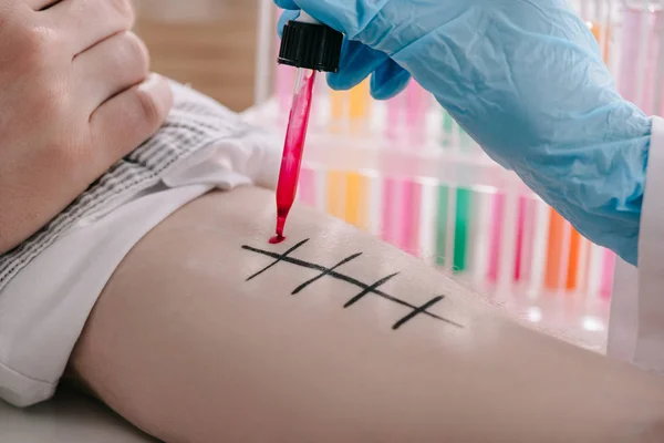 Vista recortada del médico en la celebración de la pipeta con líquido rojo cerca de la mano masculina mientras que hace la prueba de alergia en el laboratorio - foto de stock