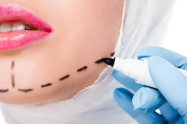 Обрезанный вид пластического хирурга в латексной перчатке держа маркер ручку рядом с девушкой с отметинами на лице изолированы на белом — стоковое фото