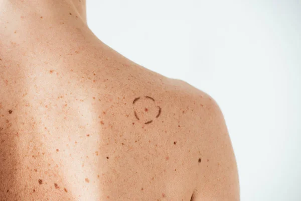 Vista cortada da mulher com marcas na pele isolada no branco — Fotografia de Stock