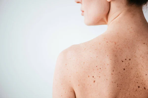 Vue recadrée de femme nue avec la maladie de peau sur blanc — Photo de stock