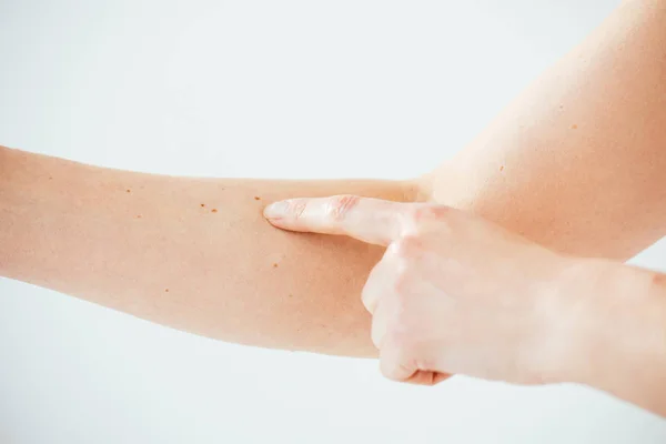 Ausgeschnittene Ansicht einer Frau, die mit dem Finger auf Melanom auf Weiß zeigt — Stockfoto