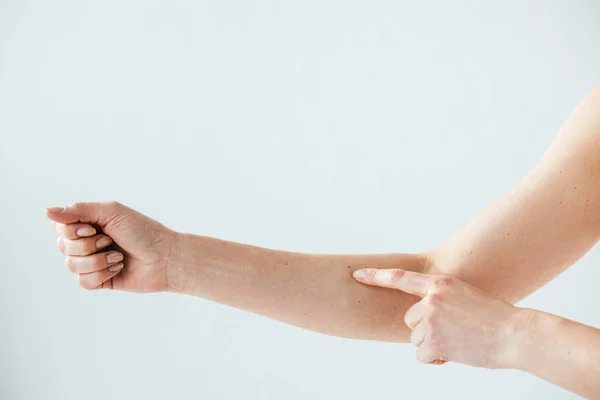 Vista ritagliata della donna che punta con il dito al neo sul bianco — Foto stock