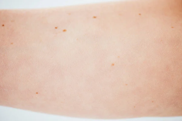 Cropped view of woman with birthmarks on white — Stock Photo