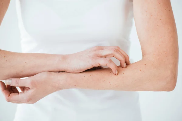 Visão cortada de mulher alérgica coçar as mãos no branco — Fotografia de Stock