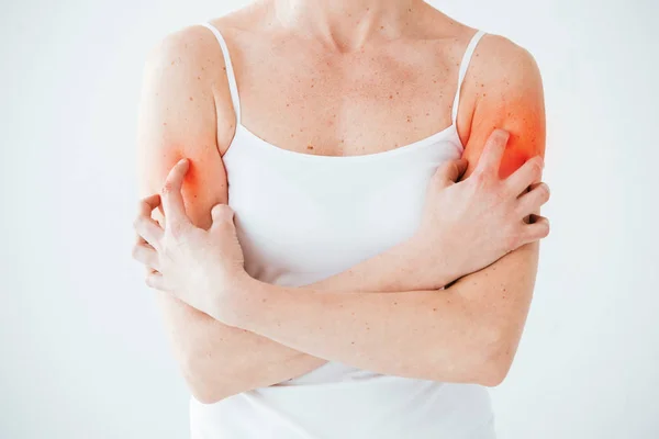 Vista ritagliata di donna con allergia graffiare la pelle rossa su bianco — Foto stock