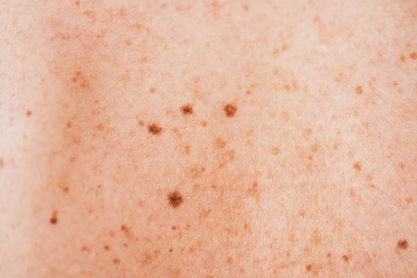 Close up of sick woman with melanoma on diseased skin — Stock Photo