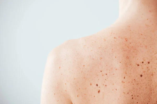 Back view of diseased woman with melanoma on skin on white — Stock Photo