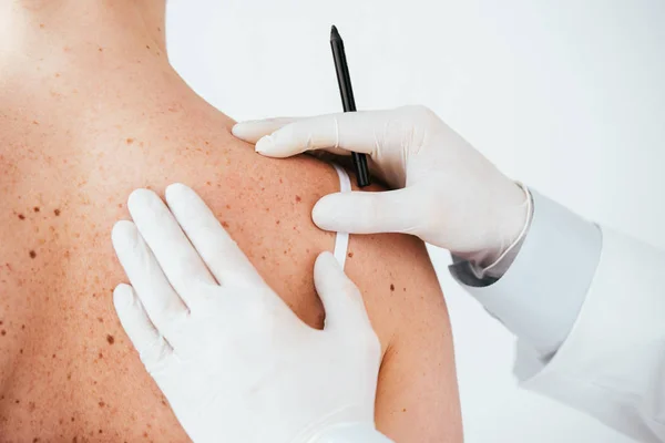 Visão recortada de dermatologista em luvas de látex segurando caneta marcador perto de mulher com melanoma isolado em branco — Fotografia de Stock