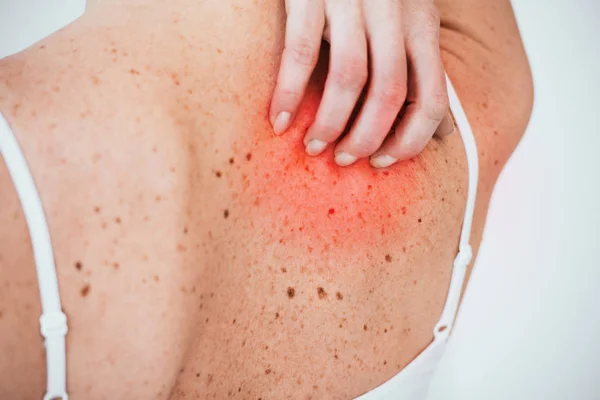 Vista ritagliata di donna allergica graffiare pelle rossa isolata su bianco — Foto stock