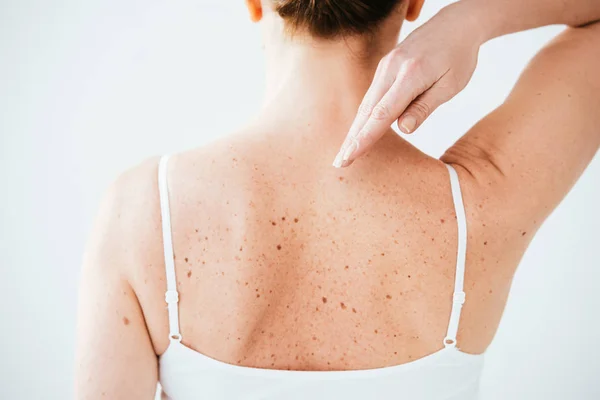 Vue arrière de la femme malade avec mélanome sur la peau isolée sur blanc — Photo de stock