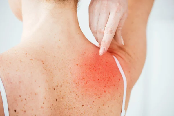 Vista ritagliata della donna che punta con il dito verso la pelle rossa isolata sul bianco — Foto stock