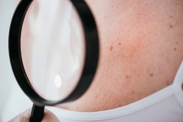 Visão cortada de dermatologista segurando lupa perto do paciente com melanoma — Fotografia de Stock