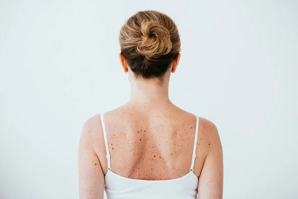 Vue arrière de la femme atteinte de mélanome sur peau malade isolée sur blanc — Photo de stock