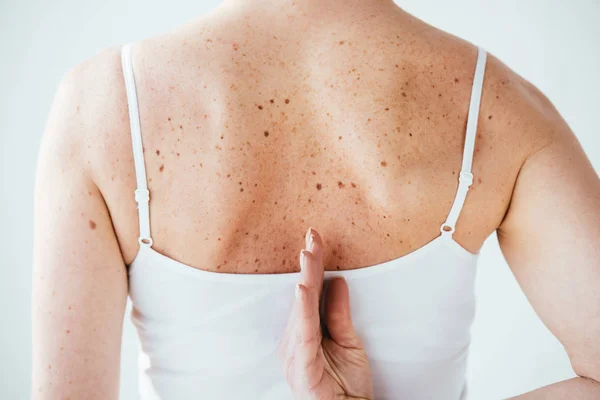 Vista ritagliata di donna con pelle malata isolata su bianco — Foto stock