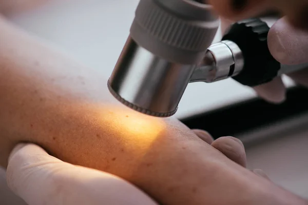Крупним планом дерматолог тримає дерматоскоп при вивченні жінки з меланомою — стокове фото