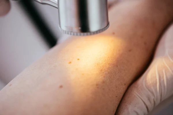 Primer plano del dermatólogo que sostiene el dermatoscopio mientras examina la mano del paciente con melanoma - foto de stock