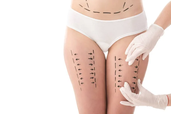 Vista parziale del chirurgo plastico in guanti di lattice e paziente in mutandina con segni sul corpo isolato su bianco — Foto stock