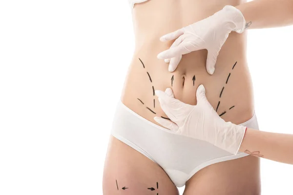 Partial view of plastic surgeon in latex gloves and patient in underwear with marks on body isolated on white — Stock Photo