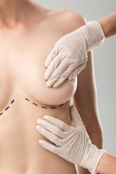 Teilaufnahme des plastischen Chirurgen mit Latexhandschuhen und Patientin mit Markierungen unter der Brust isoliert auf grau — Stockfoto