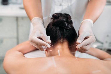 spa salonda akupunktur tedavisi sırasında çekim güzellik uzmanı koyarak iğne kadının vücudunda kırpılmış