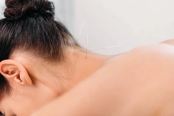 Vue Partielle Femme Ayant Acupuncture Thérapie Dans Salon Spa — Photo