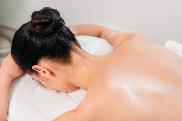 partial view of woman having acupuncture therapy in spa salon