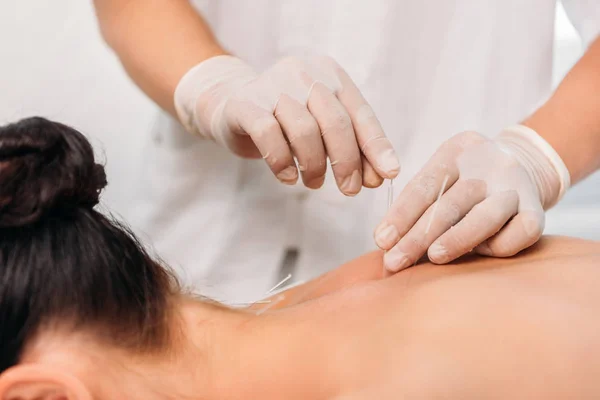 Beskuren Bild Kosmetolog Att Sätta Nålar Kvinnans Tillbaka Akupunktur Terapi — Stockfoto