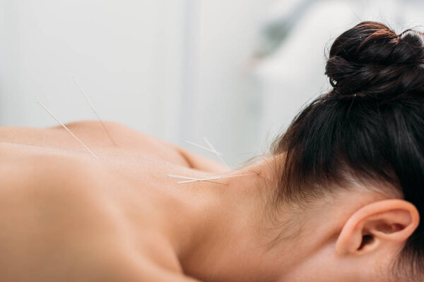 partial view of woman with needles on body having acupuncture therapy in spa salon