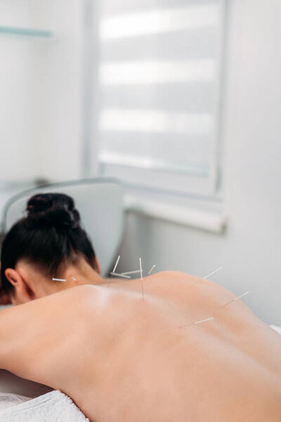 partial view of woman with needles on body having acupuncture therapy in spa salon