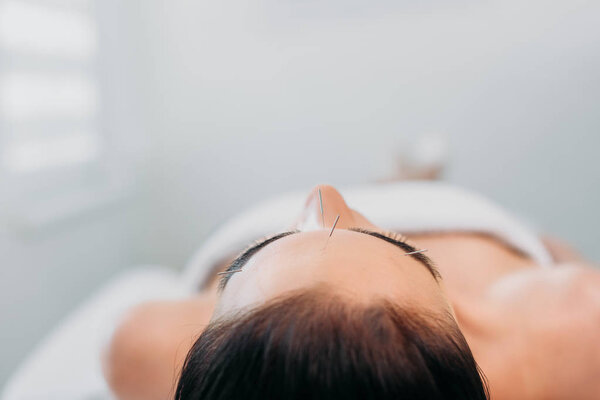 woman with needles n forehead having acupuncture therapy in spa salon