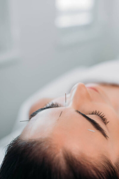 woman with needles on face having acupuncture therapy in spa salon