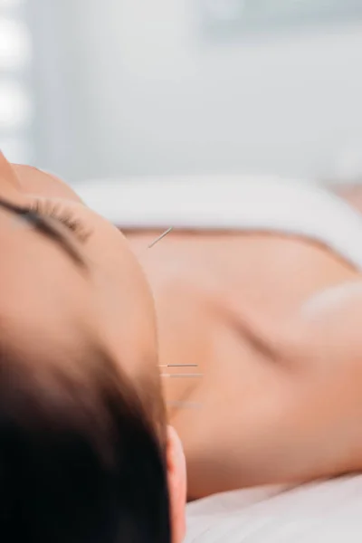 partial view of woman wih needles on face having acupuncture therapy in spa salon