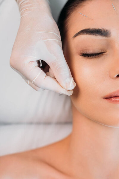 partial view of cosmetologist putting needles on womans forehead during acupuncture therapy in spa salon