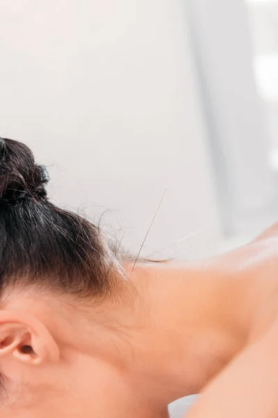 Partial view of woman having acupuncture therapy in spa salon — Stock Photo