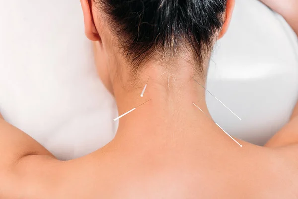 Vue partielle de la femme ayant acupuncture thérapie dans le salon de spa — Photo de stock