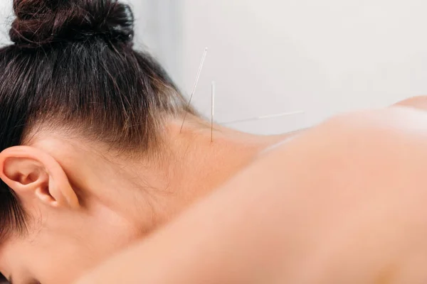 Vista parcial de la mujer que tiene terapia de acupuntura en el salón de spa - foto de stock