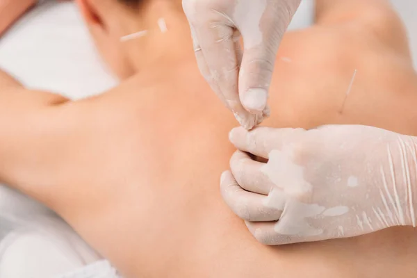 Tiro cortado de cosmetologist colocando agulhas em mulheres de volta durante a terapia de acupuntura no salão de spa — Fotografia de Stock