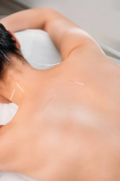 Partial view of woman with needles on body having acupuncture therapy in spa salon — Stock Photo