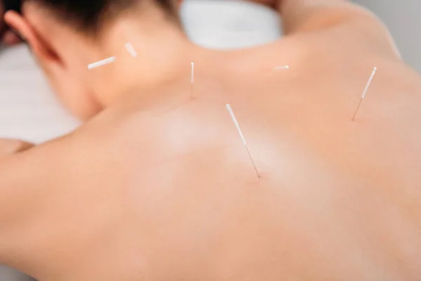 Vue partielle de la femme avec des aiguilles sur le corps ayant acupuncture thérapie dans le salon de spa — Photo de stock