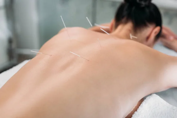 Partial view of woman with needles on back having acupuncture therapy in spa salon — Stock Photo