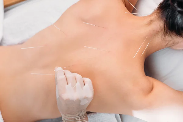 Cropped shot of cosmetologist putting needles on womans back during acupuncture therapy in spa salon — Stock Photo